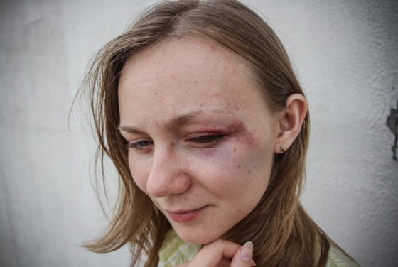 Краматорская журналистка рассказала, как ее избили в киевском троллейбусе