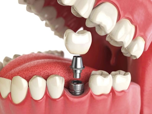 Имплантация зубов: важные особенности процедуры
