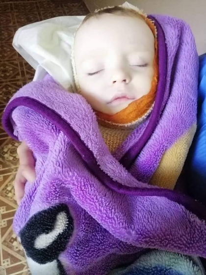 Ребенку с тяжелыми ожогами нужна помощь (фото)