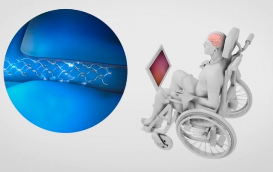 Обгонит Илона Маска: компания Synchron в этом году опробует мозговые импланты 