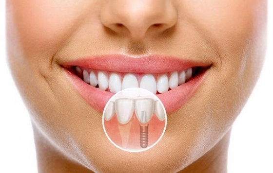 Имплантация зубов: важные особенности процедуры