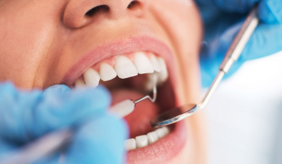 Кариес на зубах: причины и способы лечения