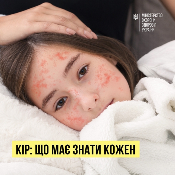 Донеччина долучилася до загальнонаціональної кампанії з вакцинації дітей проти кору