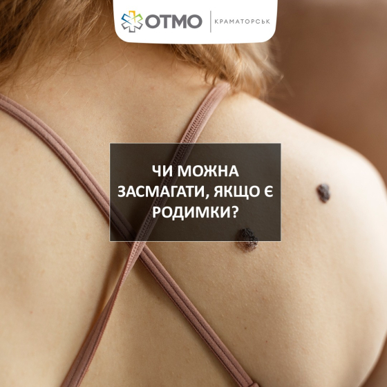 Чи можна засмагати, якщо є родимки: поради лікарів ОТМО