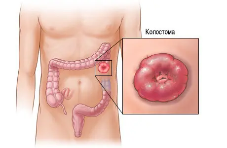 Что и как нужно делать при наличии колостомы